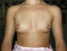 plastic-surgery-breast-augmentation 